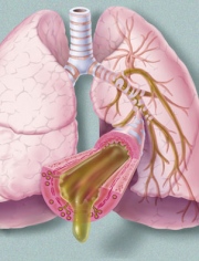 GP-10.Bronchitis