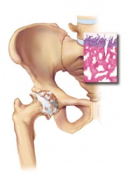 GP-13.Osteoarthritis