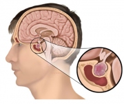 GP-19.Sphenoid.adenoma