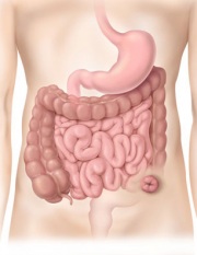 GP-23.Sigmoid.colostomy