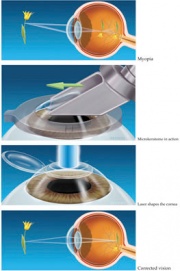 GP-27.LASIK_