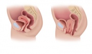 GP-6.Prolapsed.uterus