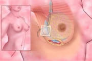 Breast Augmentation